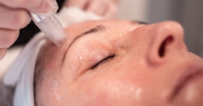 Microneedling